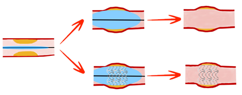 L’angioplastie ou dilatation d’artère avec ou sans pose de stent Un ballon cathéter (avec ou sans stent) est introduit dans l’artère, entrainant ainsi son élargissement, la compression de la plaque et l’augmentation de la circulation sanguine.