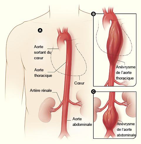 Les anévrismes artériels et leurs localisations. Un anévrisme artériel est une dilatation d’une artère, le plus souvent l’aorte abdominale, consécutive à la faiblesse de sa paroi.