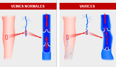 Une dysfonction valvulaire, entrainant un reflux veineux, est à l’origine de l’apparition des varices.