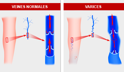 La naissance des varices. Une dysfonction valvulaire, entrainant un reflux veineux, est à l’origine de l’apparition des varices.