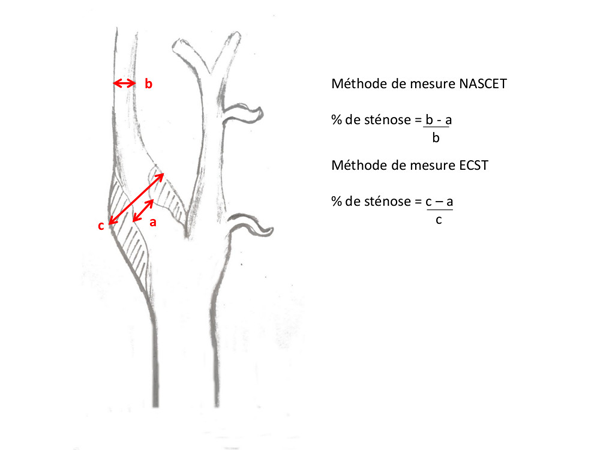 Le risque de survenue des accidents vasculaires cérébraux dépend directement du degré de sténose, d’où l’intérêt de sa quantification.