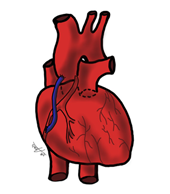 Le pontage aortocoronarien. Le pontage aortocoronarien relie l’aorte à une artère coronaire.