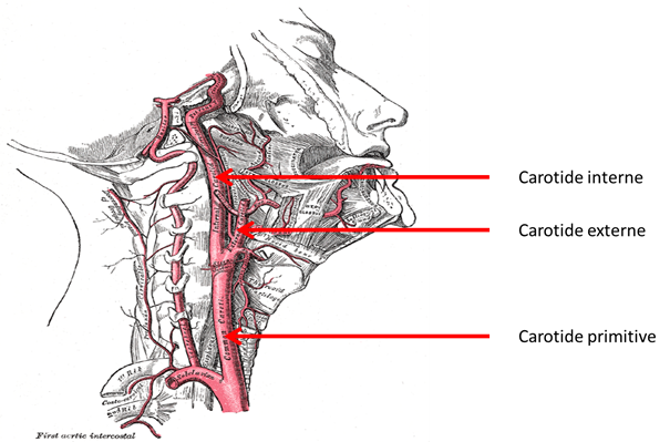 Localisation des artères carotides, les artères principales du cou. La maladie occlusive ou sténose de l’artère carotide, est un rétrécissement du calibre des artères carotides.
