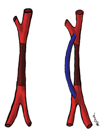 Le pontage est une technique chirurgicale consistant à créer une dérivation, afin de rétablir une circulation sanguine correcte.