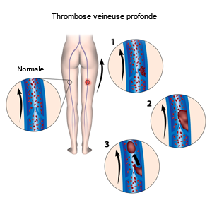 La formation d’une phlébite ou thrombose veineuse. La thrombose veineuse profonde correspond à la formation d’un caillot de sang ou thrombus dans une veine des membres inférieurs.